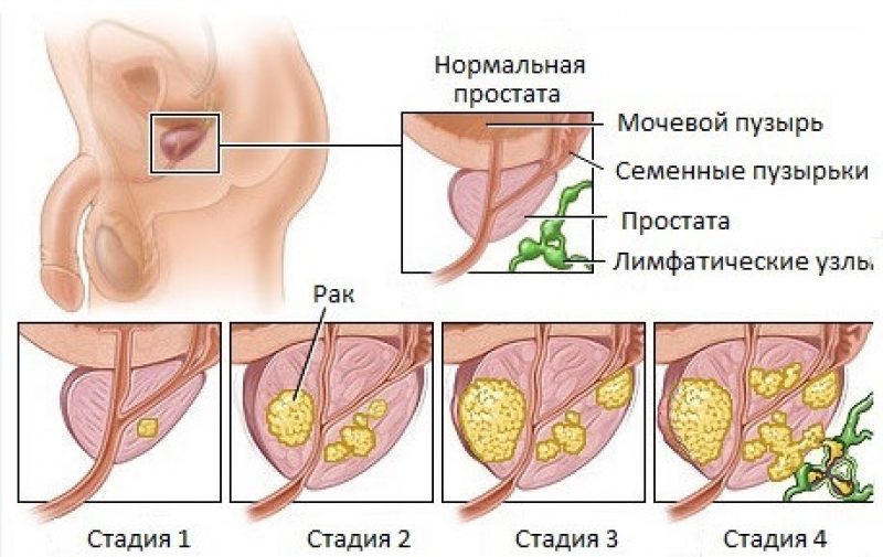 Где Находится Предстательная Железа У Мужчин Фото